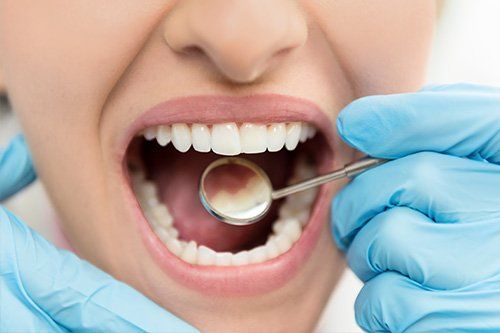 dental mirror in patient's open mouth