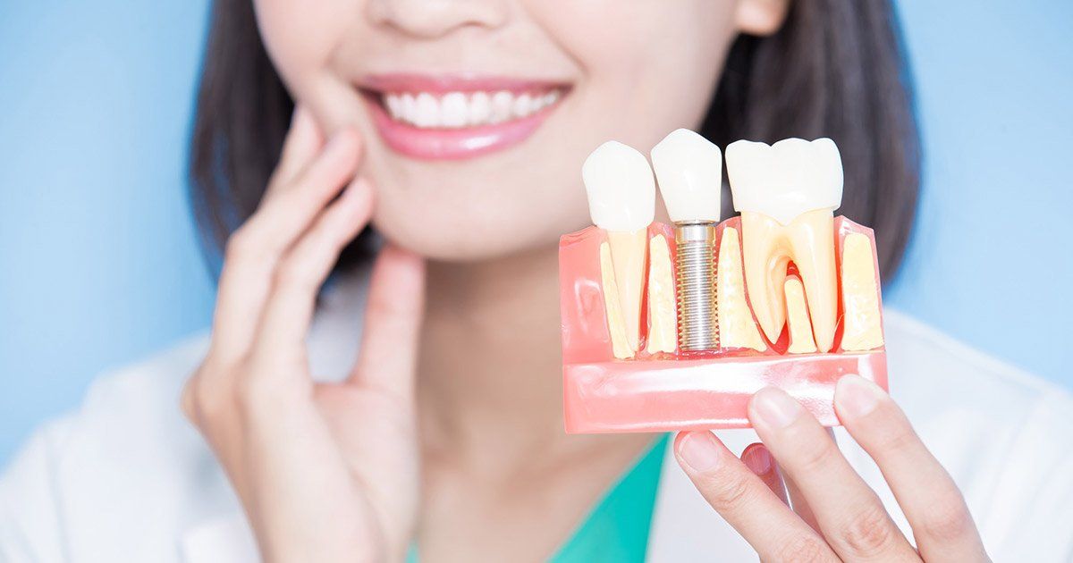 dental implants longevity
