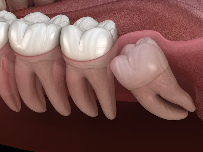 Illustration of molars with a wisdom tooth growing sideways beneath the gums