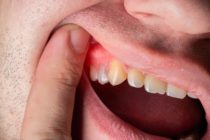 Finger pulling back upper lip to show inflamed gums and teeth in a close-up mouth exam