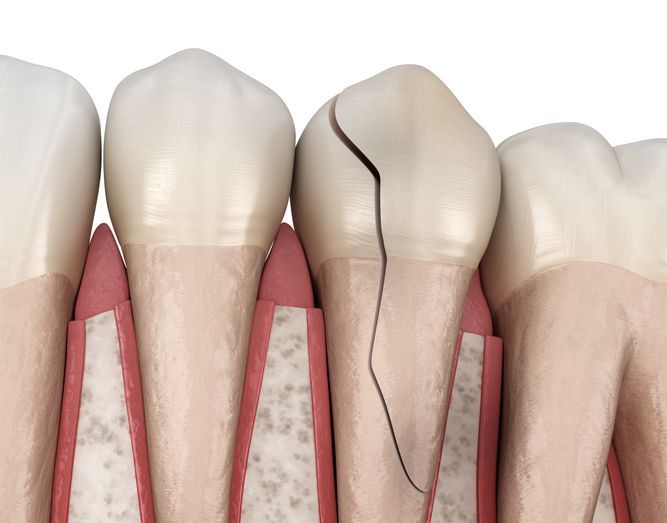 Teeth illustration showing a cracked tooth with a black fracture line