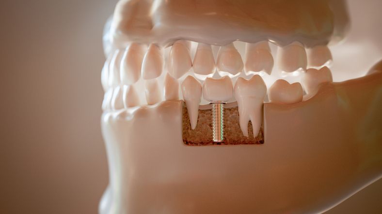 A cross-section model of a jaw showing a single dental implant positioned between two natural teeth.