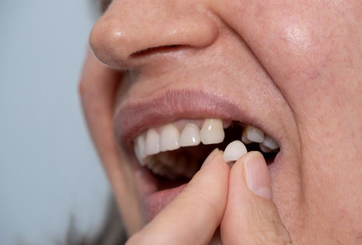 Close-up of a person placing a dental veneer on an upper front tooth