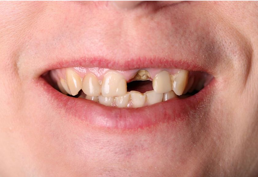 A close up of a person 's mouth with a broken tooth.