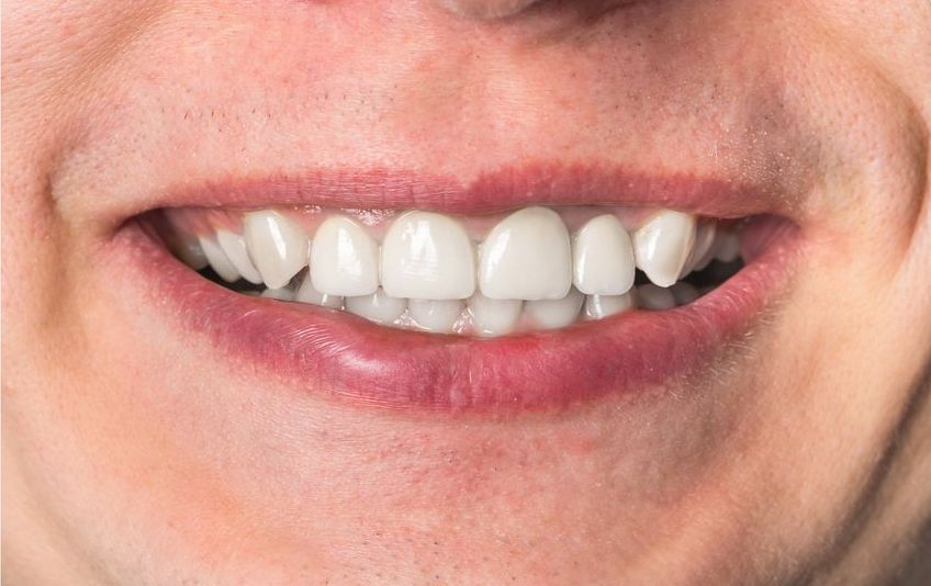 A close up of a man 's smile with white teeth.