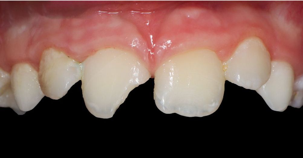 A close up of a person 's teeth with a black background.