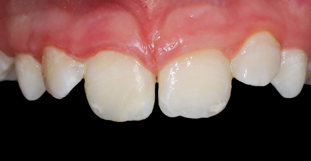 A close up of a person 's teeth with a black background.