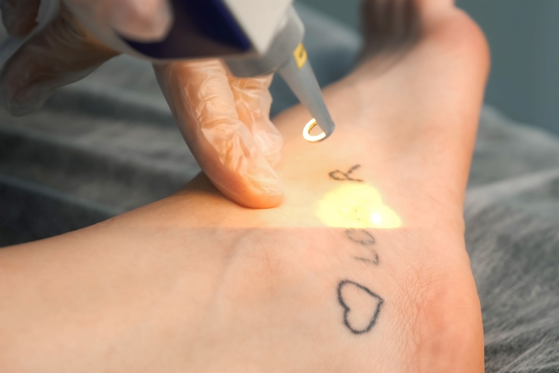 A person is getting a tattoo removed from their foot.