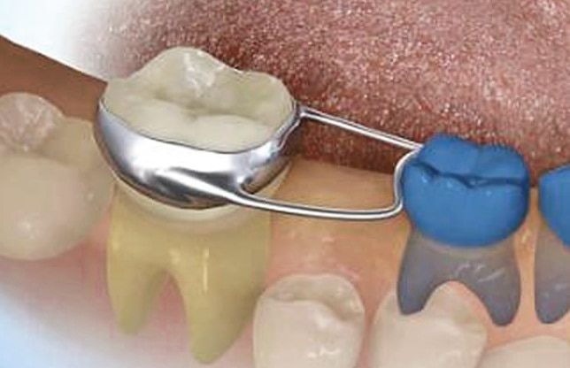 Dental illustration of a space maintainer with a metal band on a tooth. Adjacent tooth has a blue cap.