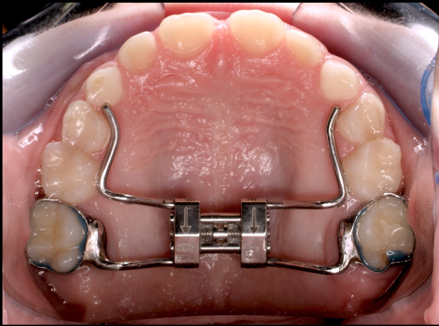 Upper view of mouth with a palatal expander appliance attached to molars.