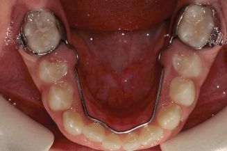 Dental palate with a fixed lower lingual arch appliance attached to molars.