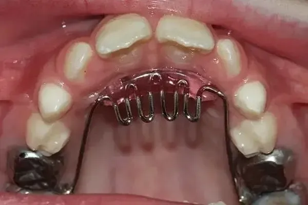 Mouth with orthodontic appliance attached to upper teeth. Pink plastic, metal wires, and silver caps on molars.