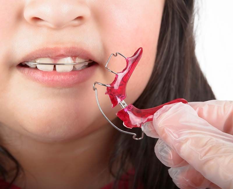A person holding a red and silver orthodontic retainer next to a person with braces.