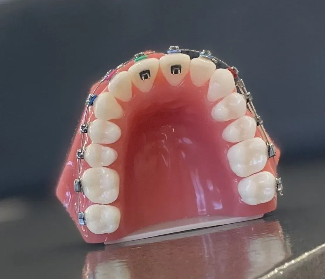 Model of teeth with metal braces.