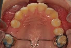 Mouth with upper teeth and a palatal expander appliance.