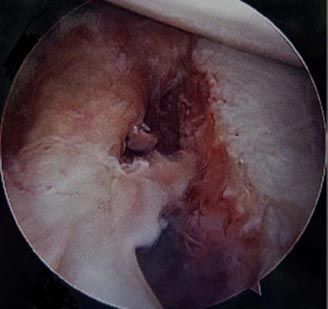 Kidney stone, urinary stone, ureteric stone, renal calculi, renal colic, nephrolithiasis