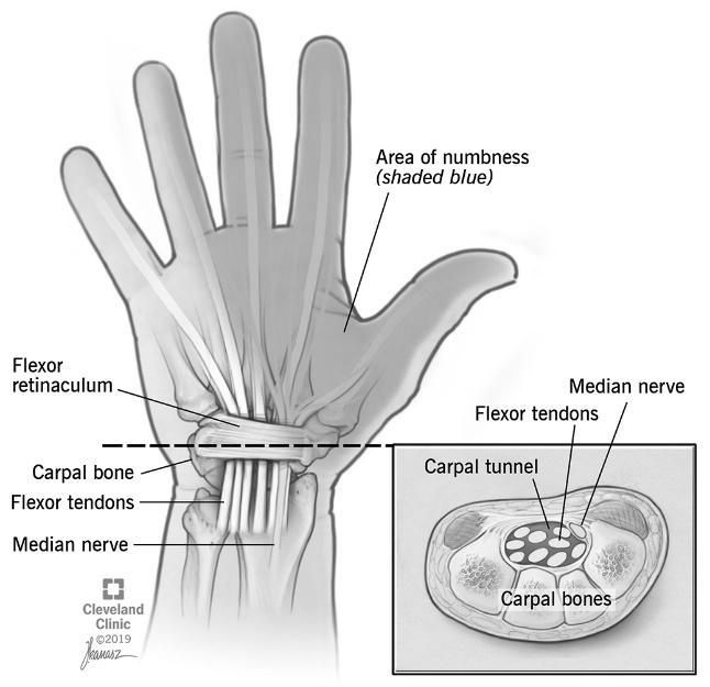 Kidney stone, urinary stone, ureteric stone, renal calculi, renal colic, nephrolithiasis