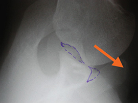 Kidney stone, urinary stone, ureteric stone, renal calculi, renal colic, nephrolithiasis