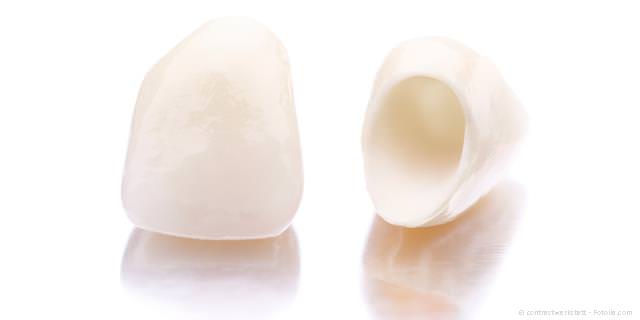 Zahnkrone Schneidezahn aus Keramik