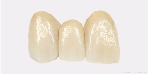 Zahnbrücken bei kleinen Zahnlücken, wenn wenige Zähne fehlen