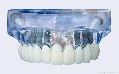 Mit Implantaten können statt herausnehmbarer Totalprothesen komplett festsitzende Zähne gemacht werden.