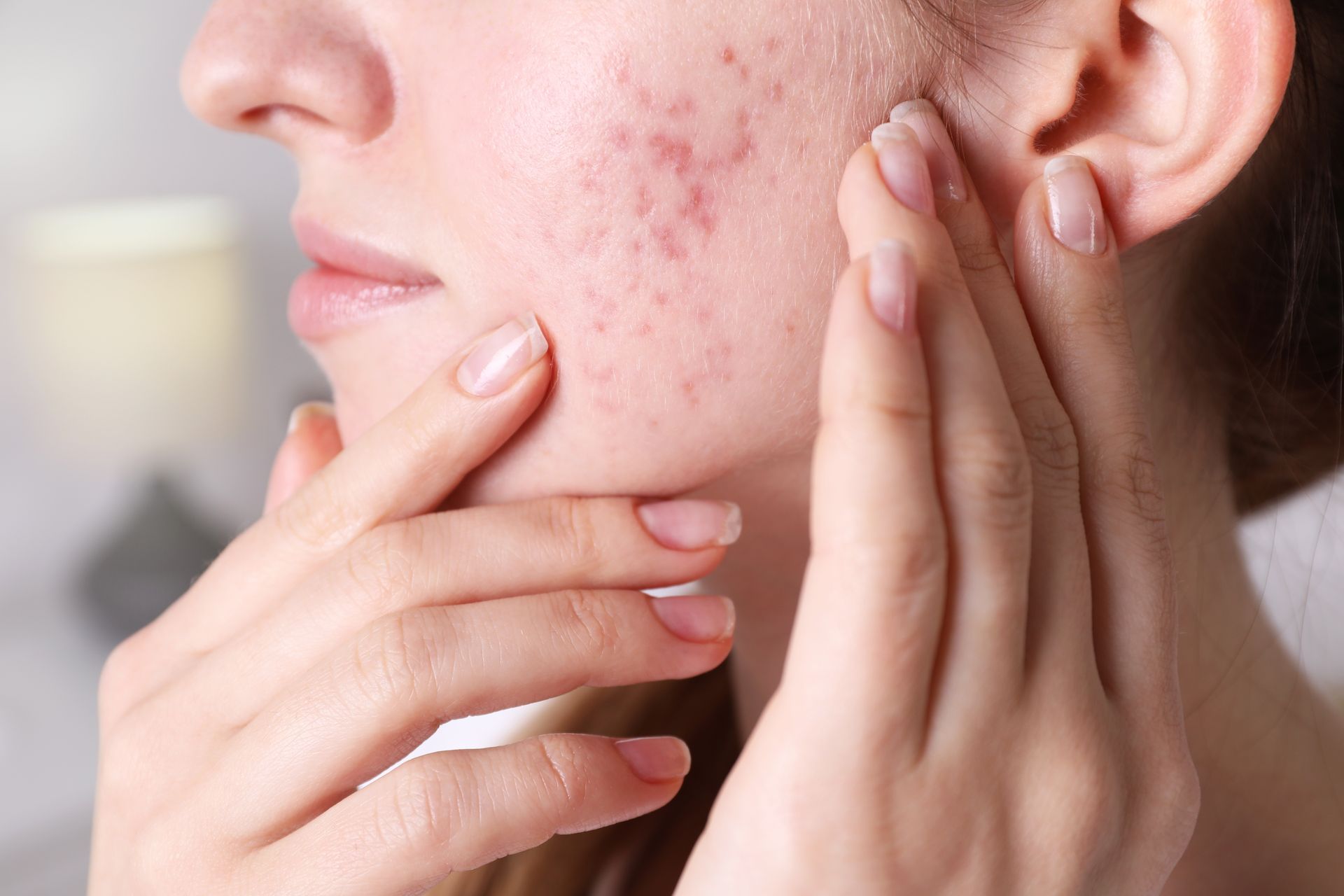 A woman with acne on her face is touching her face with her hands.