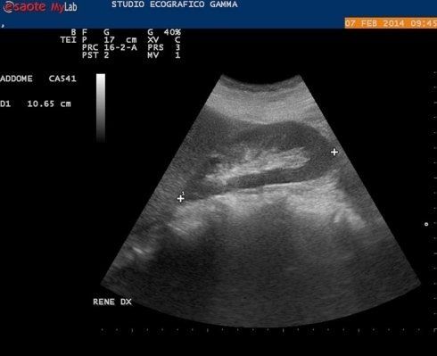 Ecografia addominale rene dx
