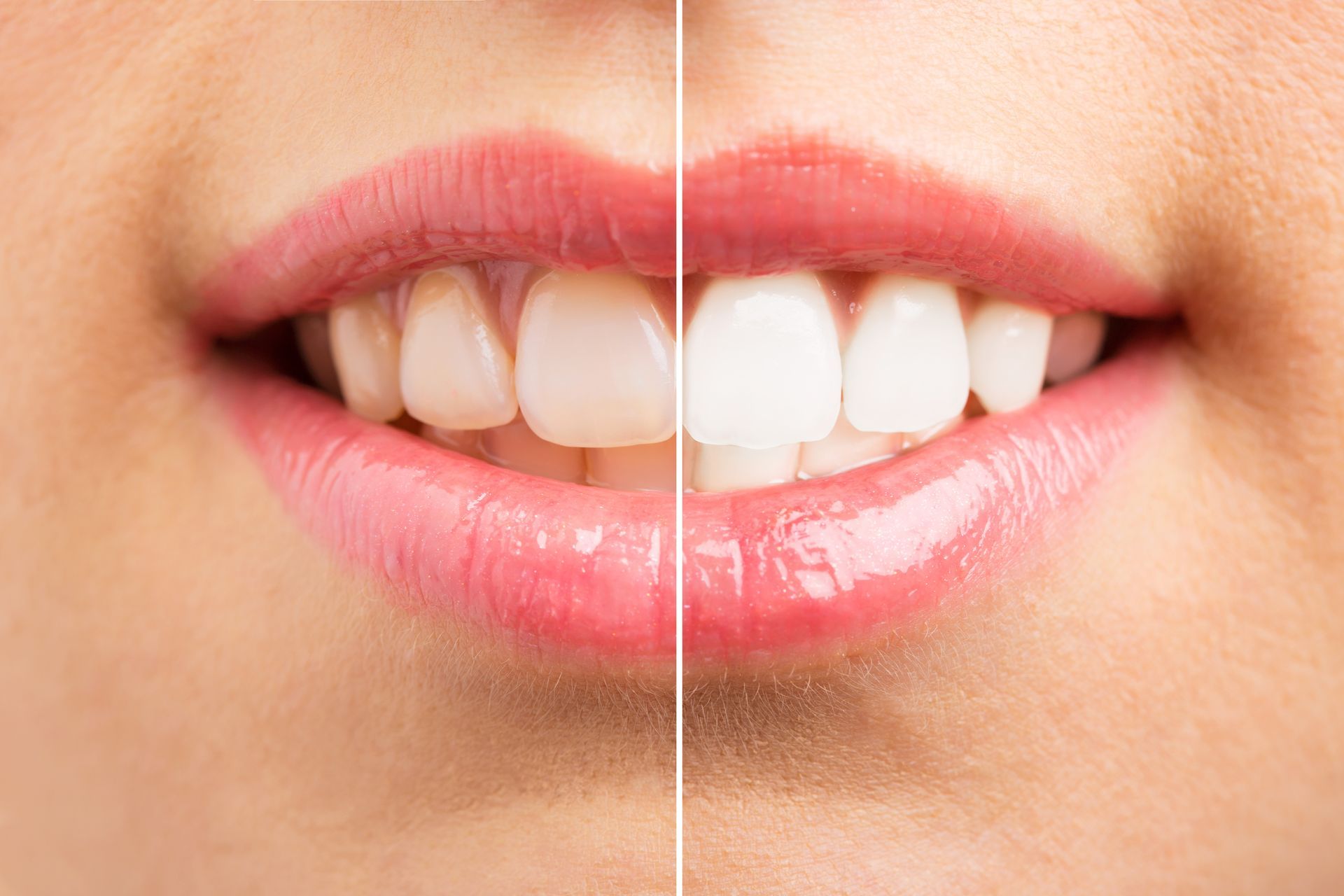 Before and after results of professional teeth whitening treatment. Before and after results of professional teeth whitening treatment.