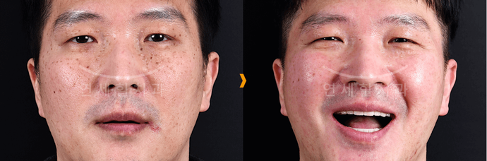 A man's face before and after a procedure, showing a change in expression from neutral to smiling with open mouth.