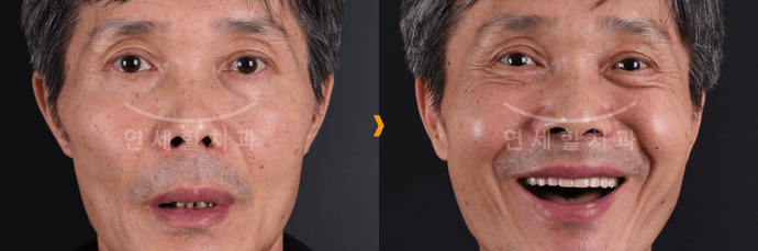 Before and after photos of a man's smile, highlighting teeth replacement. He's smiling widely in the 