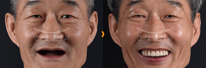 Before and after dental procedure: Smiling Asian man with new teeth.