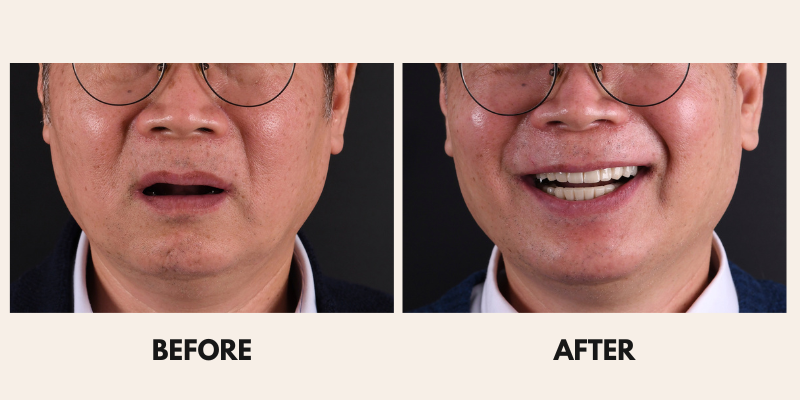 A man's face before and after a procedure, showing a change in expression from neutral to smiling with open mouth.