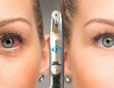 Woman's red, irritated eye next to a healthy eye with an eye treatment device held between them.
