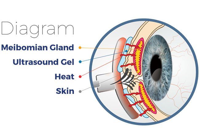 Diagram of an eye. Probe applies heat through ultrasound gel to meibomian glands within the eyelid.