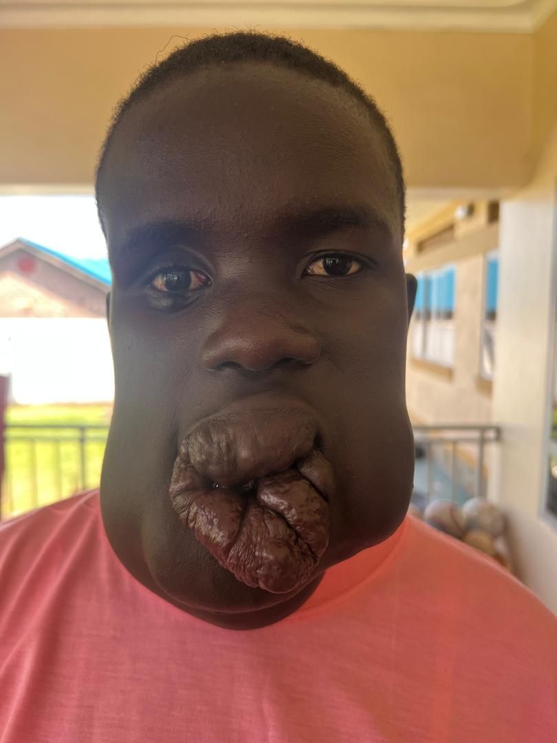 Man with enlarged lips and cheeks, wearing a pink shirt, outdoors.