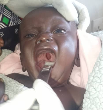 Baby with cleft palate being examined, mouth open, gloved hands, indoor setting.