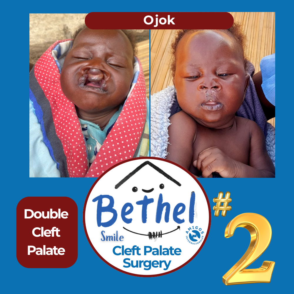 Before and after photos of a baby with a double cleft palate. The 