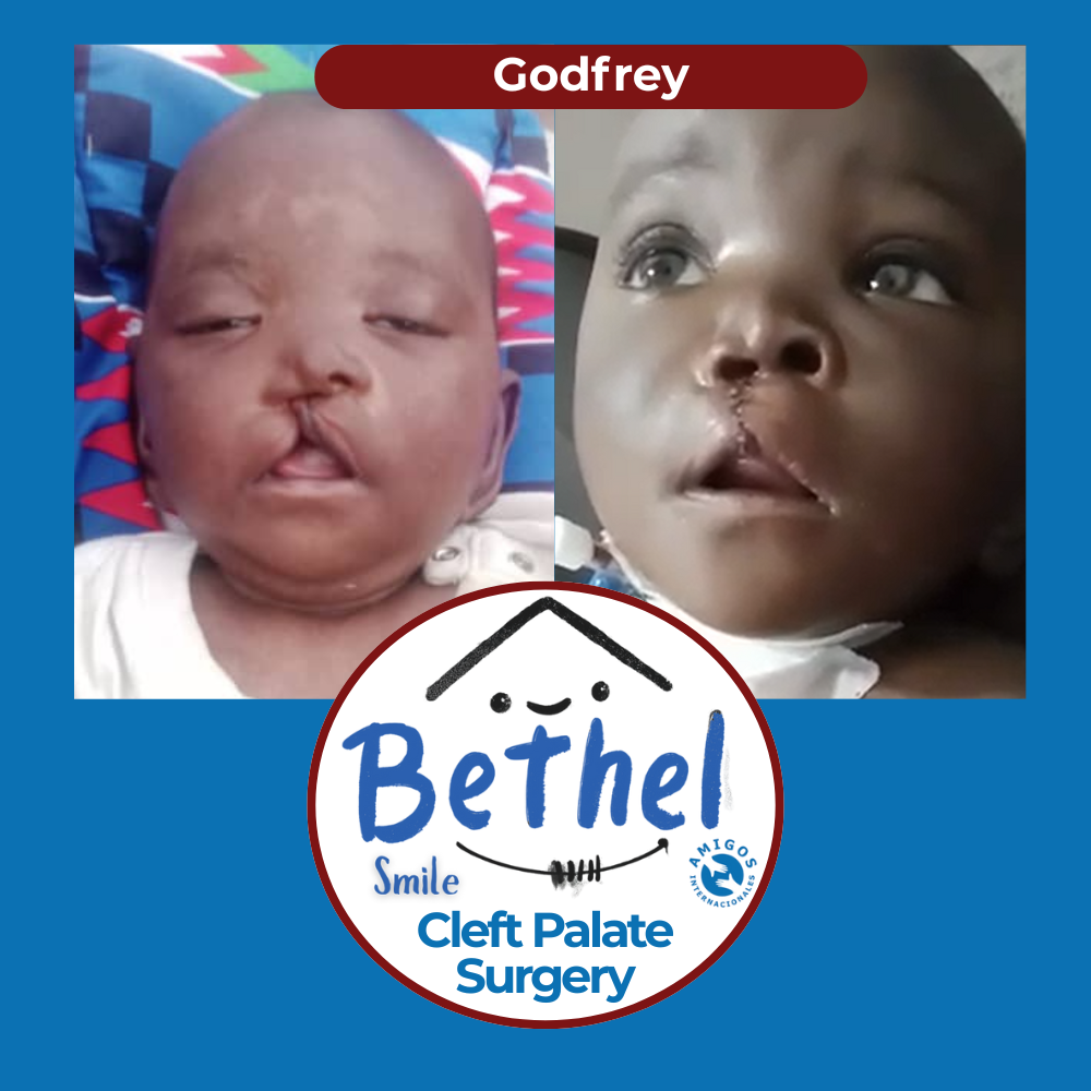 Rwottwero Godfrey before and after cleft lip surgery — Bethel Smile program, Amigos Internacionales