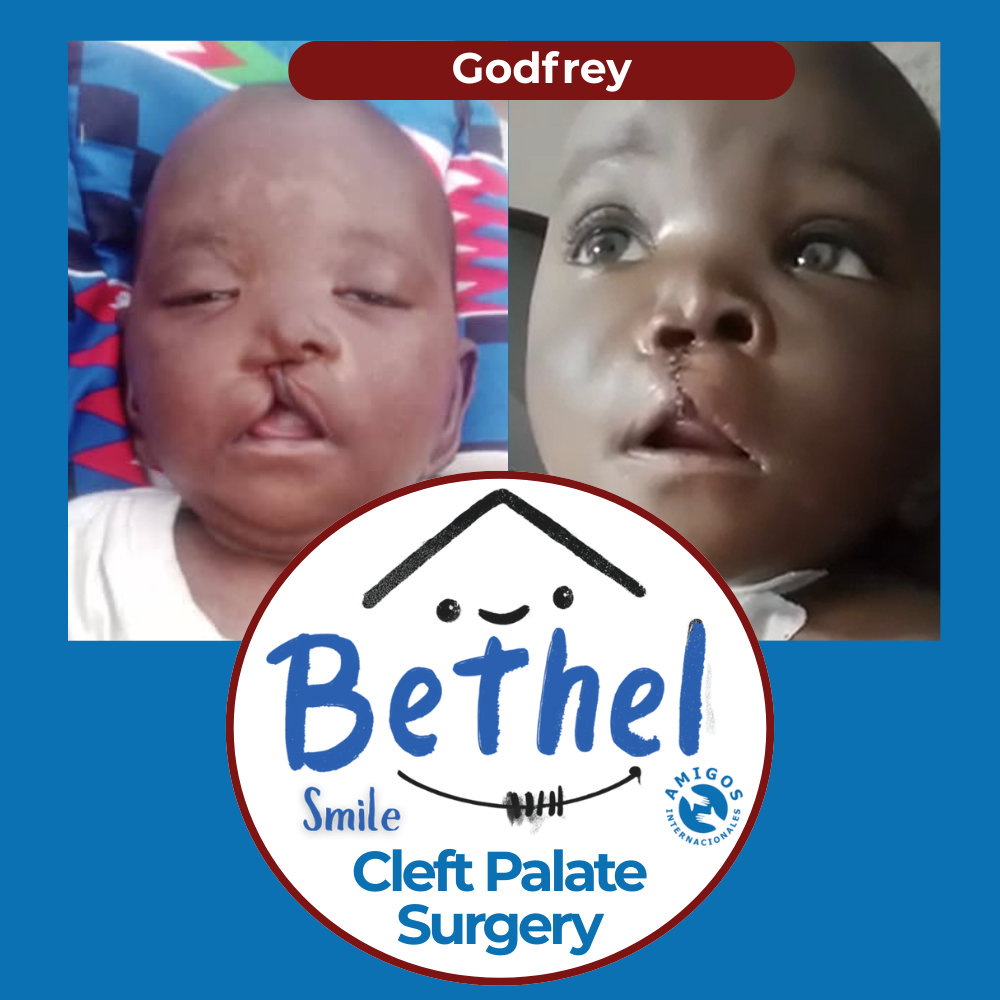 Before and after photos of a child with a cleft lip, promoted by Bethel Smile Cleft Palate Surgery.
