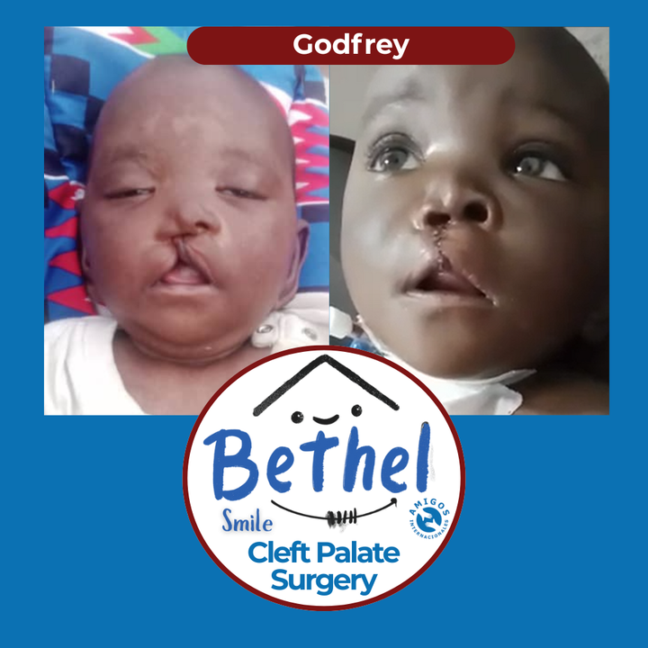 Before-and-after photos of a baby’s cleft lip repair with Bethel Smile Cleft Palate Surgery logo