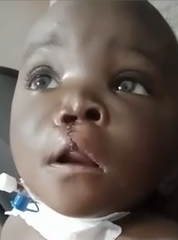 Baby with a cleft lip and a feeding tube looking up, soft expression, indoors.