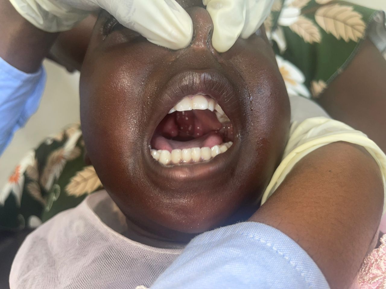 Child's mouth open, showing teeth and inflamed tissue in throat; held open by gloved hands.
