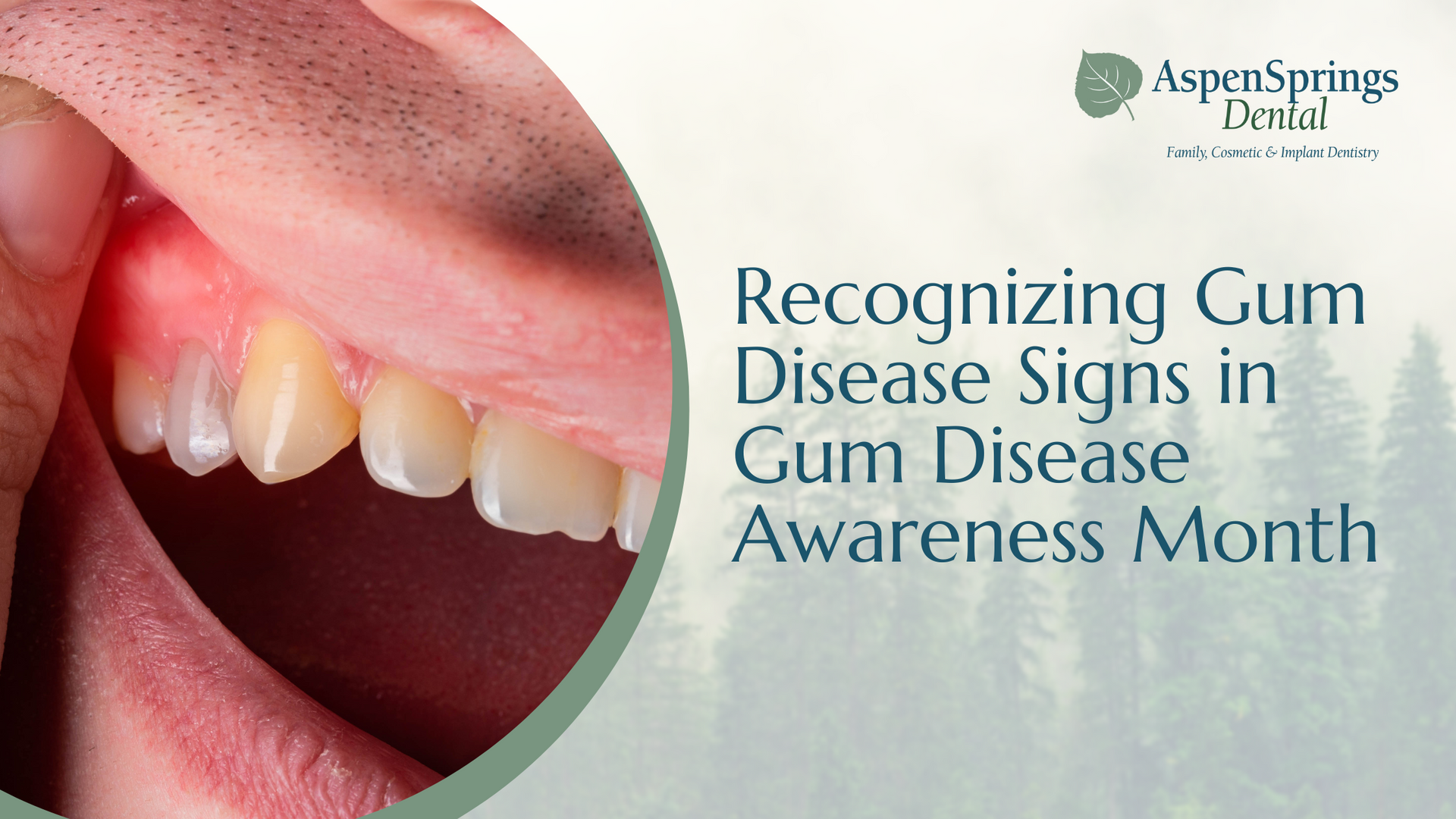 aspen springs dental is recognizing gum disease signs in gum disease awareness month .