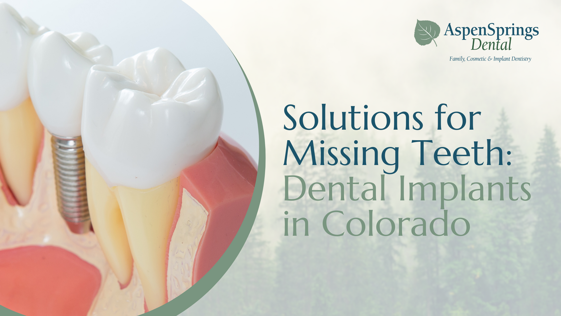A picture of a tooth with a dental implant in colorado
