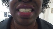 Woman with dentures — Dental implant Restoration in Gurnee, IL