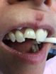 Teeth before — Dental implant Restoration in Gurnee, IL
