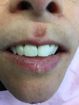 Teeth after — Dental implant Restoration in Gurnee, IL