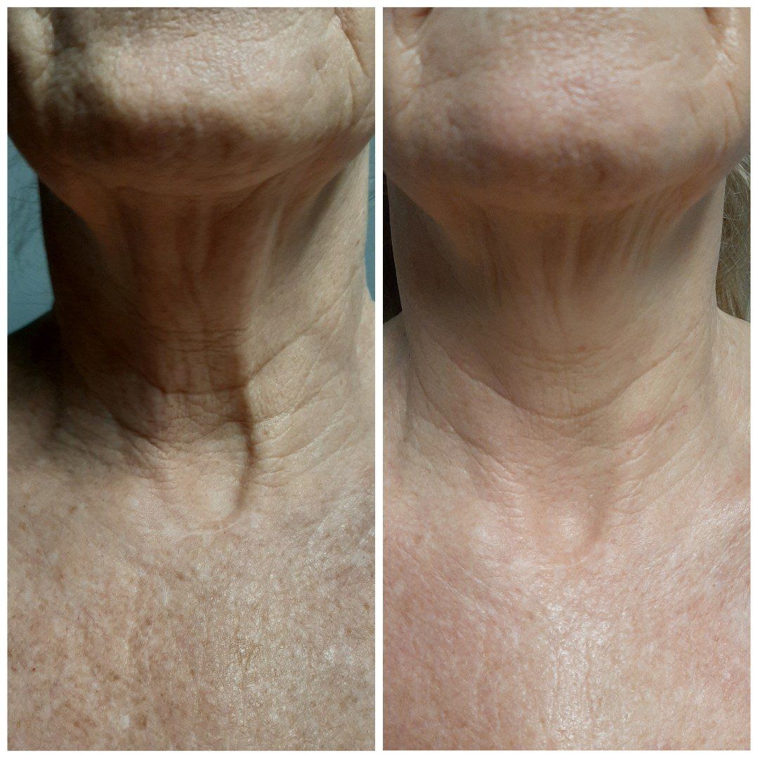 A before and after photo of a woman 's neck and chest.