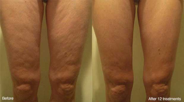 A before and after photo of a person 's legs