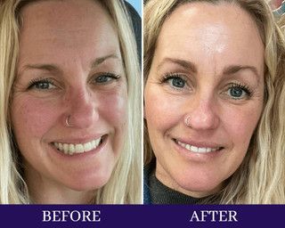 How Contour Light harnesses Red Light Therapy for Fat Loss
